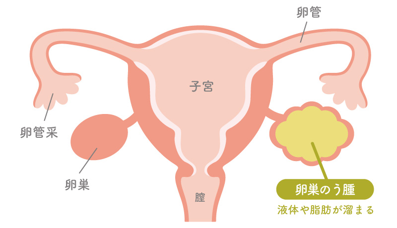 卵巣のう腫の種類