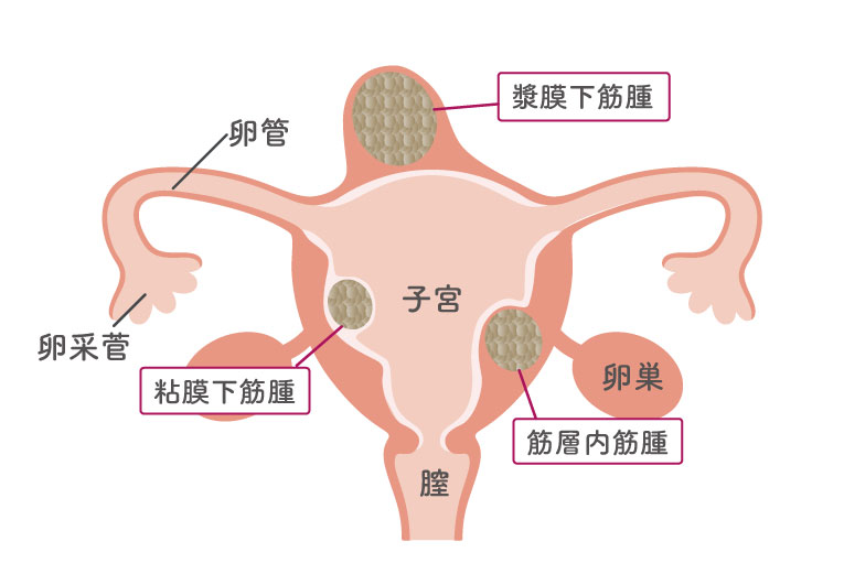 子宮筋腫の図解