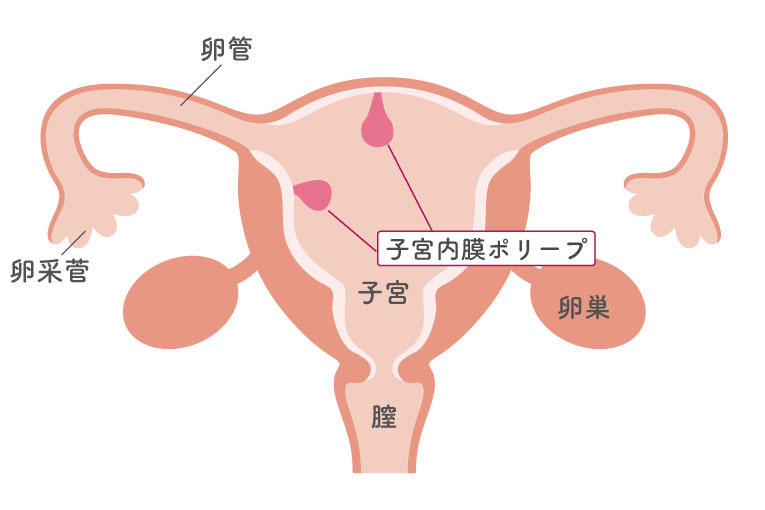 子宮内膜ポリープの図解