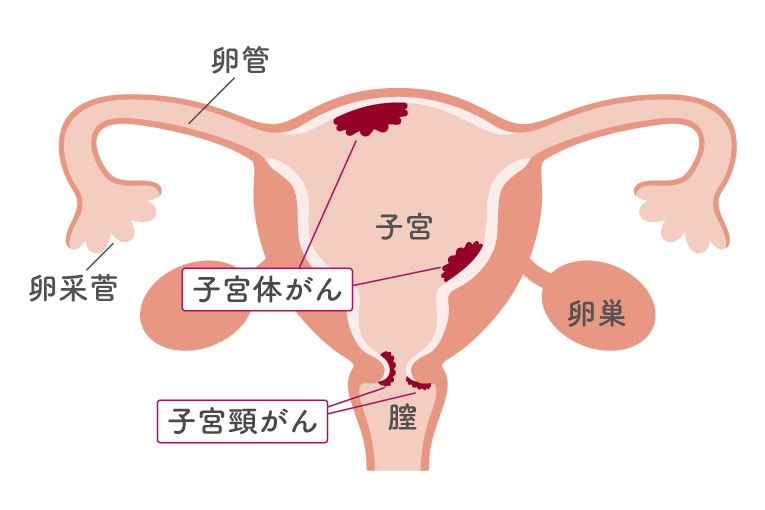 子宮頸がん・体がんの図解