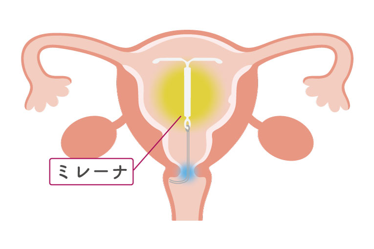 ミレーナ（子宮内黄体ホルモン放出システム）の子宮内留置時の図解