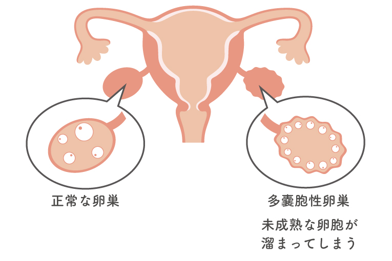 正常な卵巣と多嚢胞性卵巣の違いを表した図