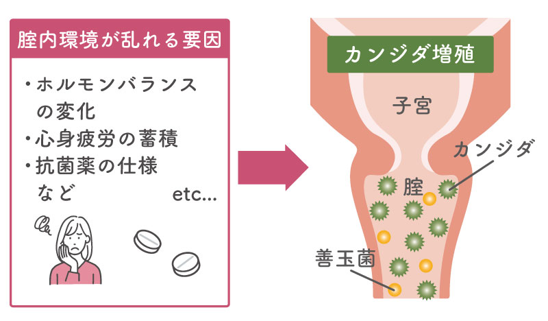 腟内でカンジダが増殖する要因