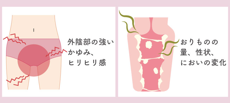 外陰部と腟内のカンジダによる症状