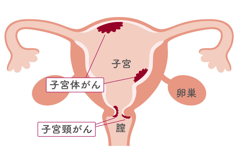 子宮頸がんと子宮体がんの発生部位