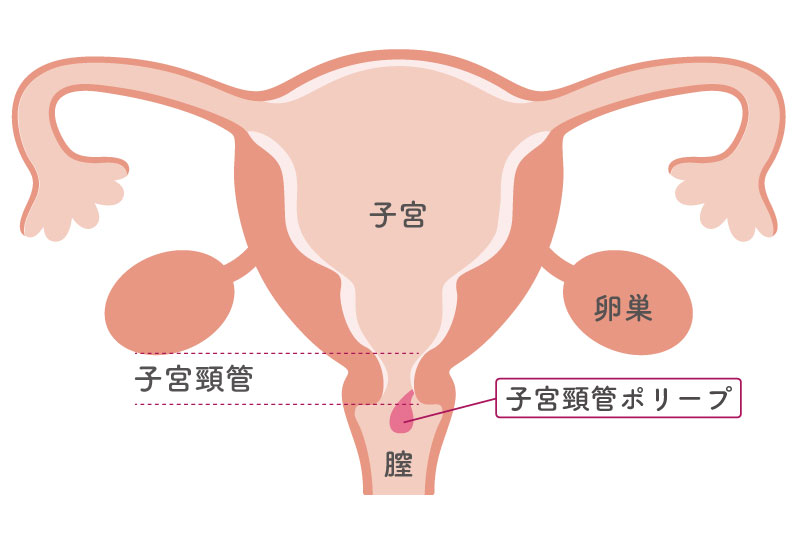 子宮頸管ポリープの発生箇所