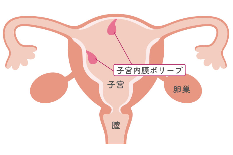 子宮内膜ポリープの発生箇所