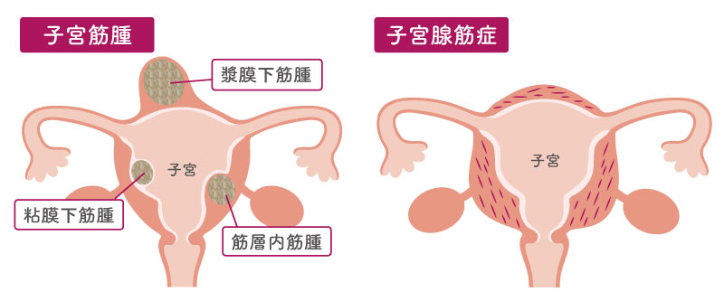 子宮筋腫、子宮腺筋症