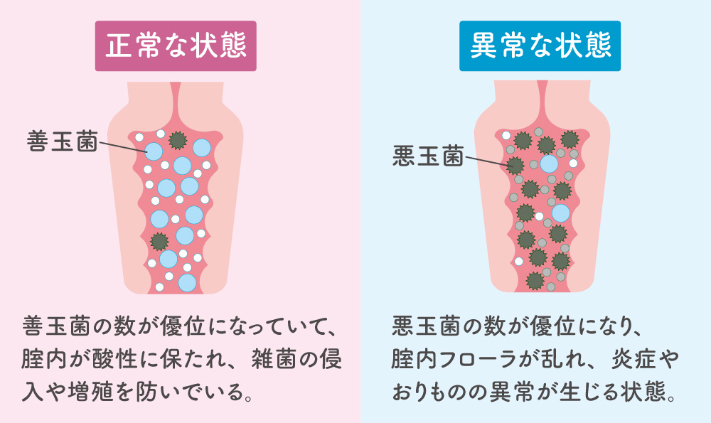 正常な腟内の状態と異常な腟内の状態