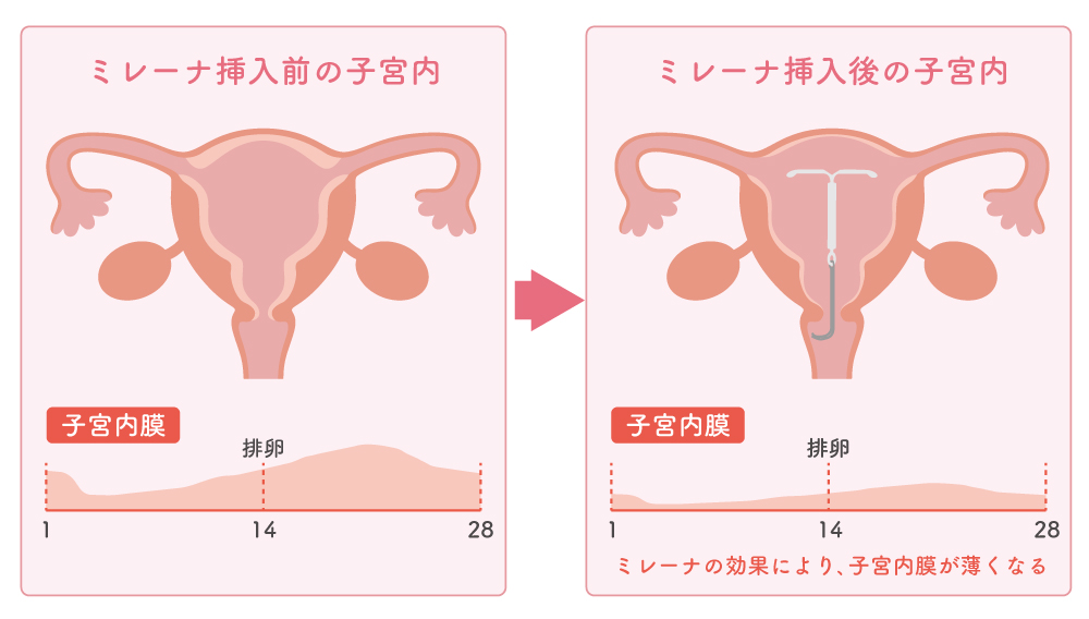 ミレーナによる子宮内膜を薄く保つ効果