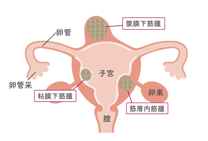子宮筋腫