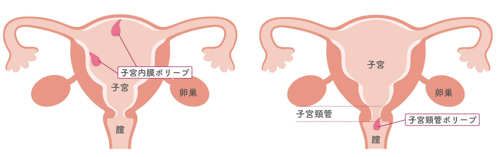 閉経後の出血の原因：子宮内膜ポリープ・子宮頸管ポリープ