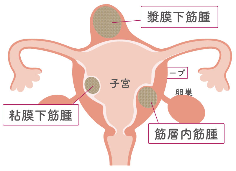閉経後の出血の原因：子宮筋腫